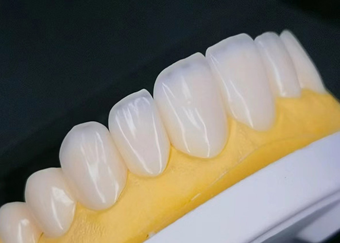 EMAX Porcelain Veneer with Stain Resistance for Natural looking Esthetic Restorations