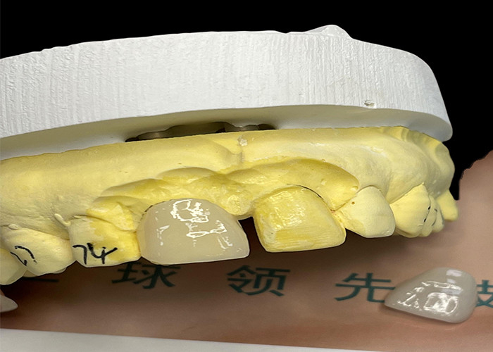EMAX Porcelain Veneer with Stain Resistance for Natural looking Esthetic Restorations