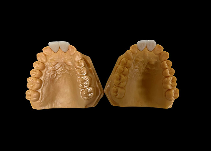 Customized Aesthetic Zirconia Dental Crown Perfectly Fitted for Anterior and Posterior Teeth