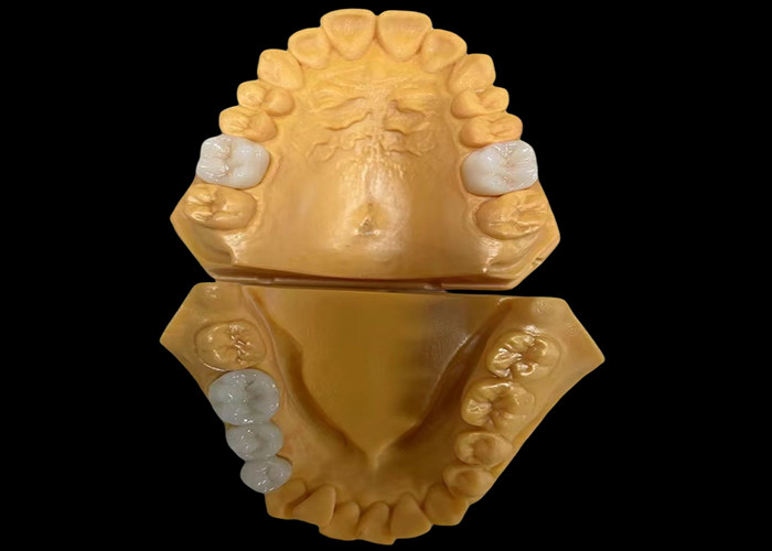 Customized Aesthetic Zirconia Dental Crown Perfectly Fitted for Anterior and Posterior Teeth