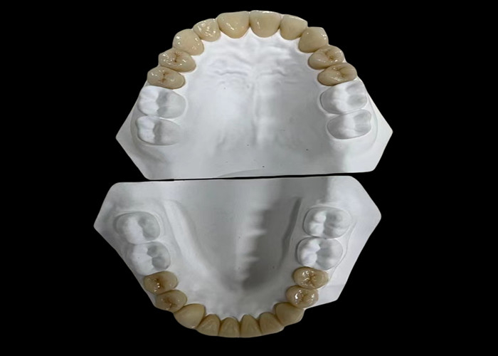 Comfortable Porcelain Dental Bridge with All-Ceramic Construction for Exceptional Wear Resistance