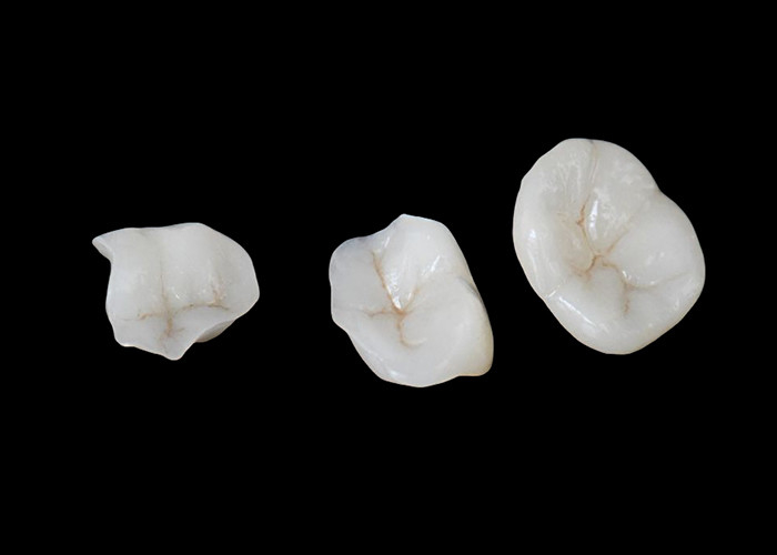 Biocompatible Ceramic Inlays and Onlays Designed for Comfort Durability and Seamless Integration with Natural Teeth