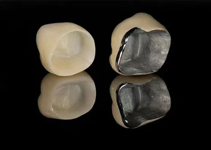 Natural Looking Porcelain Fused To Metal Crown For Restoring Damaged Teeth