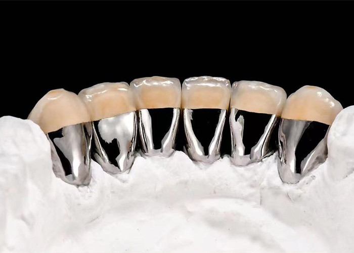 Natural Looking Porcelain Fused To Metal Crown For Restoring Damaged Teeth