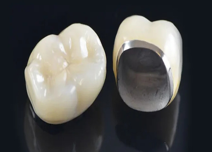 Natural Looking Porcelain Fused To Metal Crown For Restoring Damaged Teeth