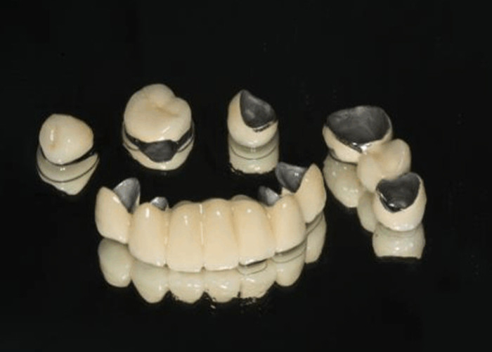 Porcelain Fused To Metal PFM Crown Dental Wear Resistance For Restorative Dentistry