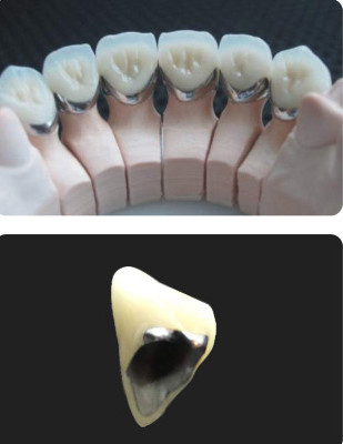 Porcelain Fused To Metal PFM Crown Dental Wear Resistance For Restorative Dentistry