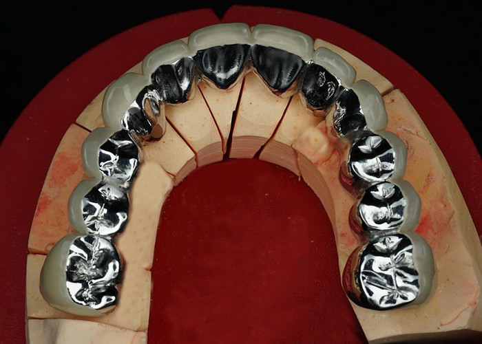 Highly Durable Restoration Porcelain Fused To Metal Crown For Natural Looking Smile
