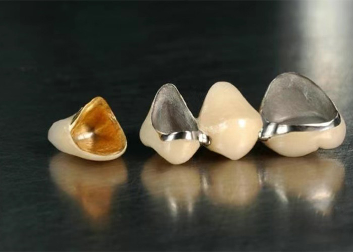 Highly Durable Restoration Porcelain Fused To Metal Crown For Natural Looking Smile