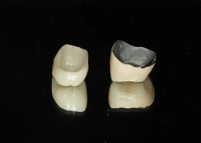 Highly Durable Restoration Porcelain Fused To Metal Crown For Natural Looking Smile