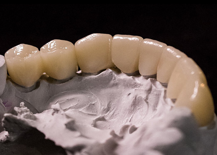 Porcelain Fused to Metal Crowns - Advanced Technology for Long Lasting Smile Restoration
