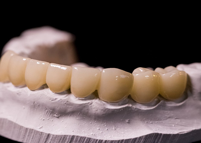 Porcelain Fused to Metal Crowns - Advanced Technology for Long Lasting Smile Restoration