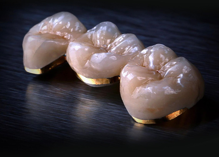 Porcelain Fused to Metal Crowns - Advanced Technology for Long Lasting Smile Restoration