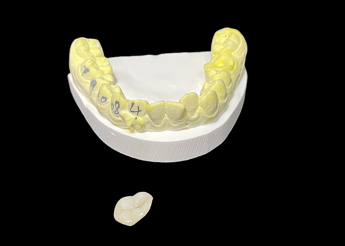 Custom Made Dental Ceramic Inlays and Onlays for Restorative Solutions and Repair of Damaged Teeth
