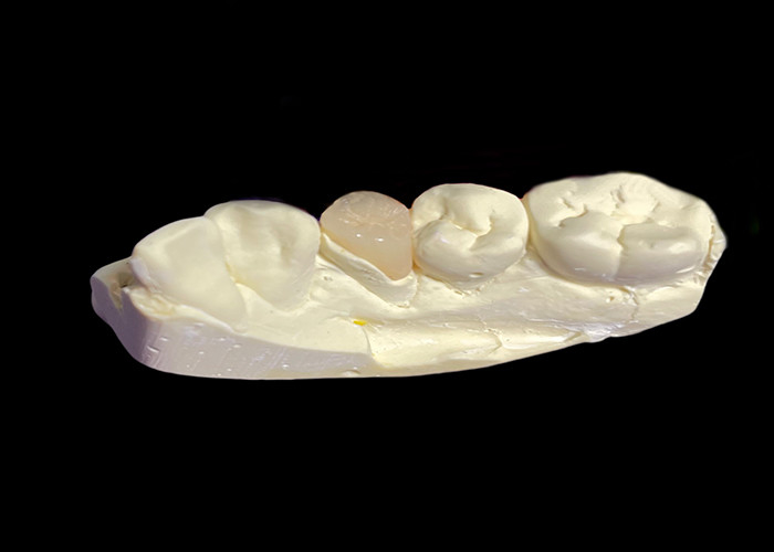 Custom Made Dental Ceramic Inlays and Onlays for Restorative Solutions and Repair of Damaged Teeth