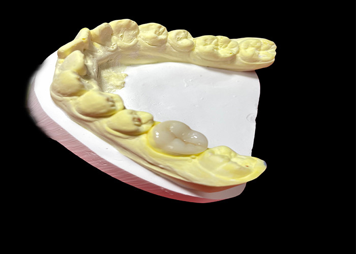 High-Quality Ceramic Inlays and Onlays for Seamless and Long-Lasting Tooth Restoration