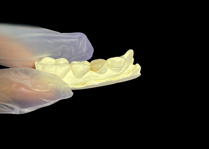 Ceramic Dental Inlay Onlay for Effective Teeth Repair with Durable and Aesthetic Porcelain Solutions for Long-Lasting Restoration