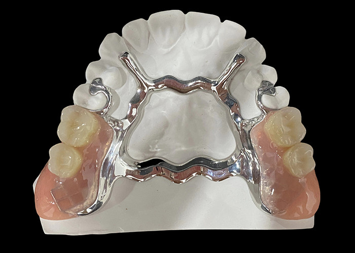 Metal Base and Acrylic Resin Partial Removable Denture for a Secure Fit and Natural Appearance