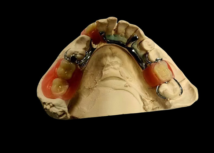 Metal Base and Acrylic Resin Partial Removable Denture for a Secure Fit and Natural Appearance