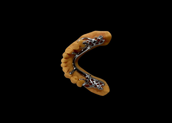 Metal Base and Acrylic Resin Partial Removable Denture for a Secure Fit and Natural Appearance