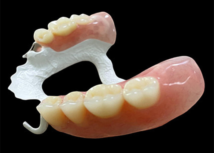 Customized Partial Removable Denture with High-Performance Polymer (HPP) Framework for Superior Comfort and Durability