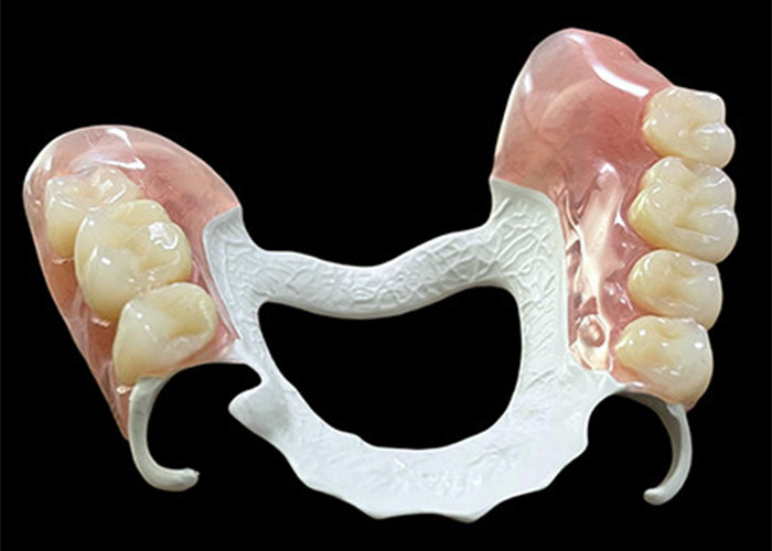 Customized Partial Removable Denture with High-Performance Polymer (HPP) Framework for Superior Comfort and Durability