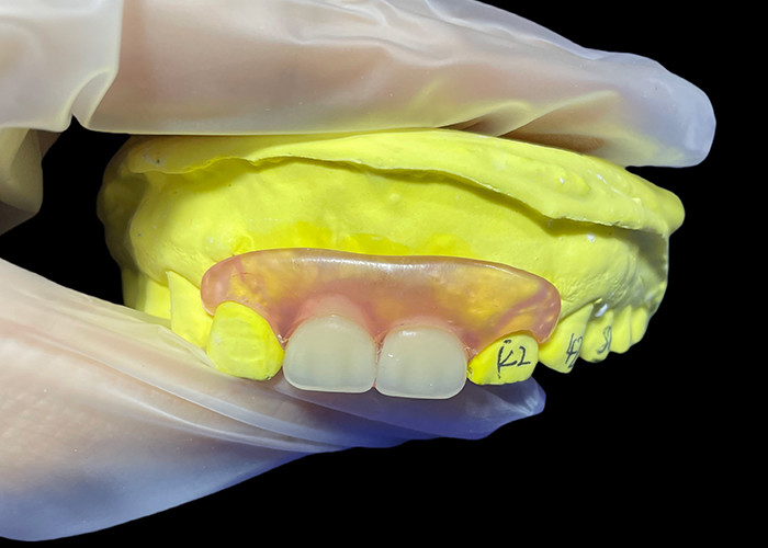 Tailored Secure Fit invisible Flexible Parital Denture Replacement For Comfortable Chewing And Speaking