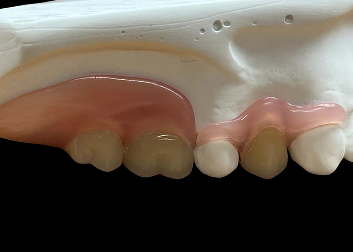 Adjustable Invisible Flexible Denture: Secure Fit for Comfortable Chewing and Speaking with Varying Durability