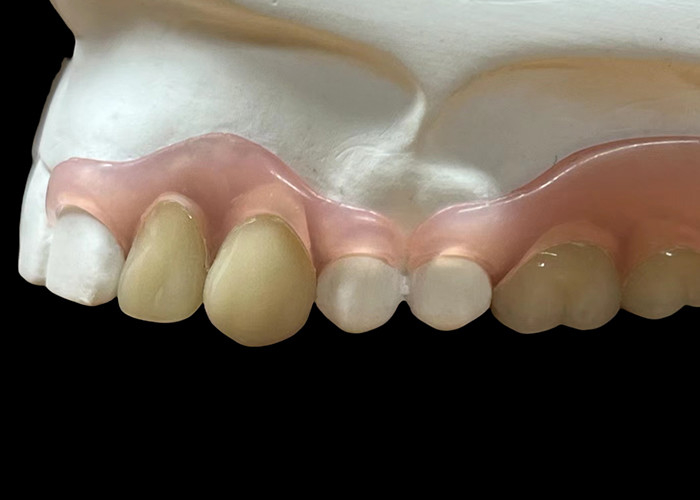 Adjustable Invisible Flexible Denture: Secure Fit for Comfortable Chewing and Speaking with Varying Durability