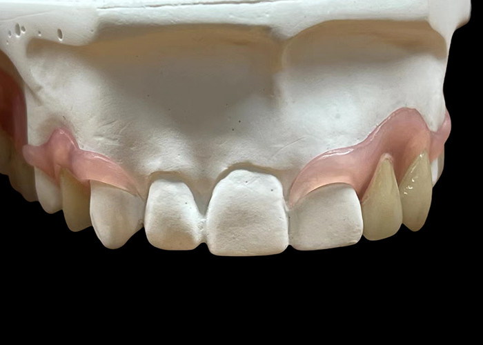 Tailored Secure Fit invisible Flexible Parital Denture Replacement For Comfortable Chewing And Speaking