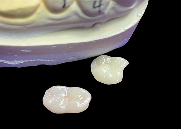 IPS e.max Ceramic Inlays and Onlays for Molar Restoration Natural Aesthetic and Superior Durability for Long-Lasting Results