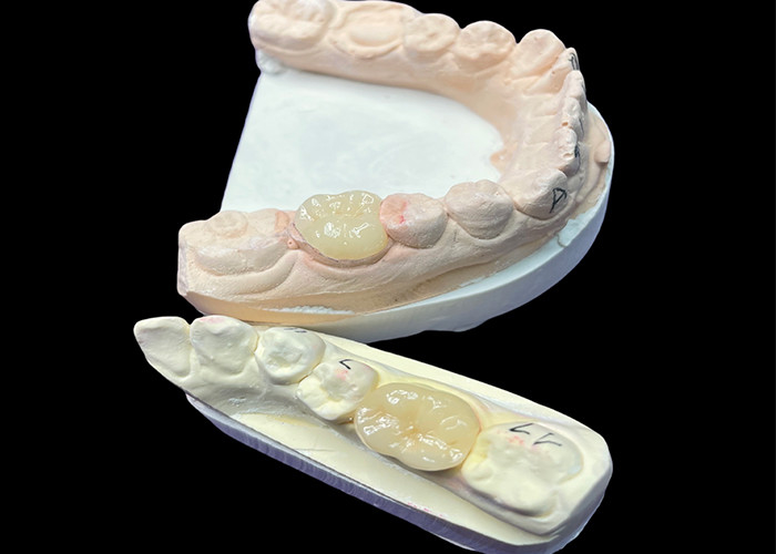 IPS e.max Ceramic Inlays and Onlays for Molar Restoration Natural Aesthetic and Superior Durability for Long-Lasting Results
