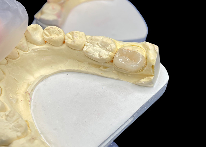 IPS e.max Ceramic Inlays and Onlays for Molar Restoration Natural Aesthetic and Superior Durability for Long-Lasting Results