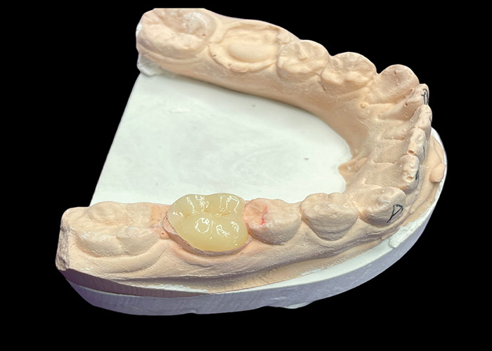 Custom Smooth Dental Ceramic Inlay for Staining Resistant Seamless Tooth Repair and Natural Aesthetic