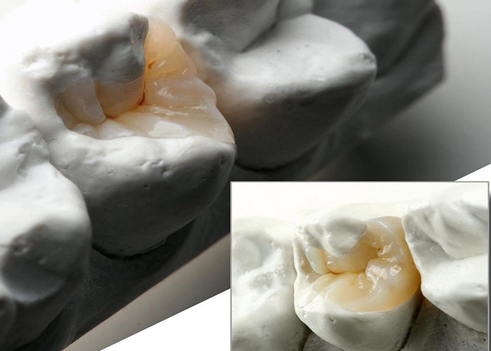 Natural Looking Ceramic Inlays and Onlays for Precise Dental Restoration from Our Expert Dental Lab