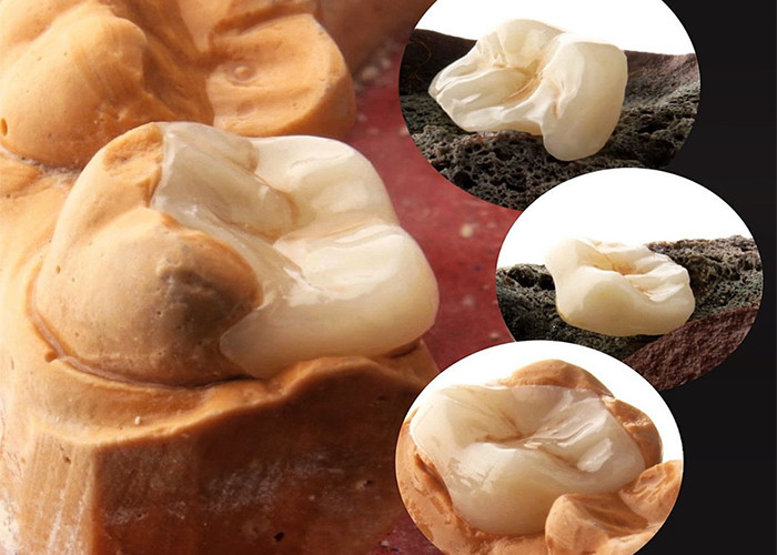 Natural Looking Ceramic Inlays and Onlays for Precise Dental Restoration from Our Expert Dental Lab