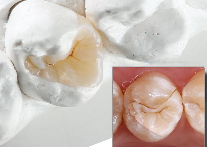 Natural Looking Ceramic Inlays and Onlays for Precise Dental Restoration from Our Expert Dental Lab