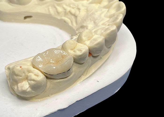 Hypoallergenic Porcelain Inlays Onlays for Teeth Repair Natural Color and Easy Maintenance