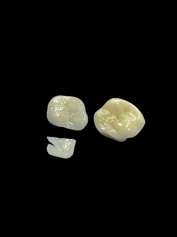 Hypoallergenic Porcelain Inlays Onlays for Teeth Repair Natural Color and Easy Maintenance