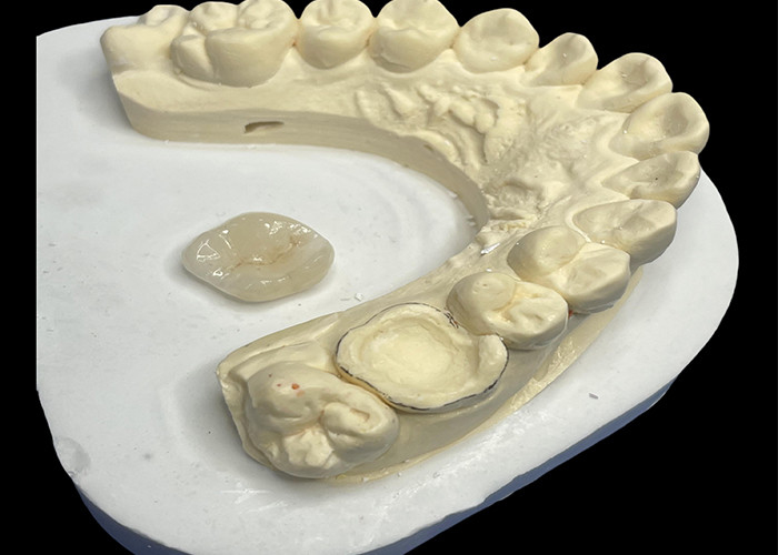 Ceramic Dental Inlay Onlay for Effective Teeth Repair with Durable and Aesthetic Porcelain Solutions for Long-Lasting Restoration