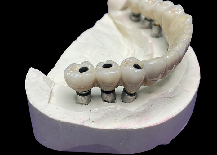 The Dental Implant With A Titanium Base Is Topped With A Beautiful Ceramic Crown Bridge To Create A Perfect Restoration.