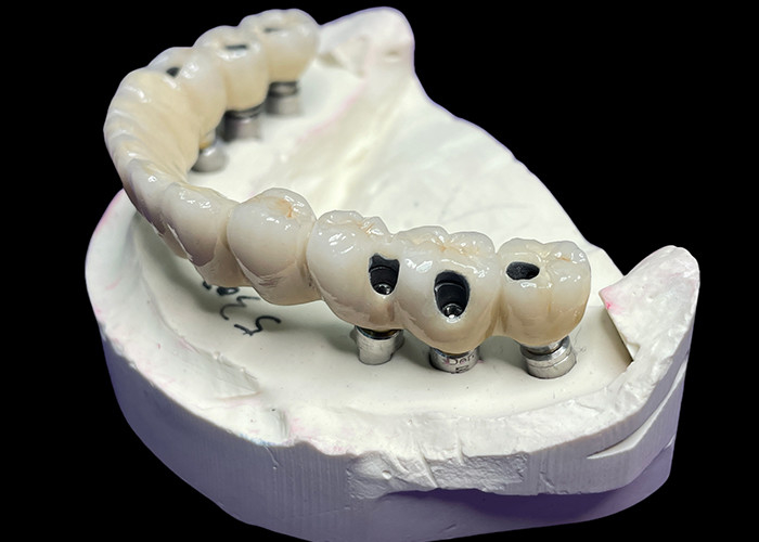 Full Arch Dental Implant Crowns and Bridges Restoring Function and Aesthetics with Advanced Solutions