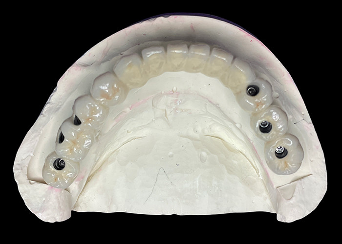 The Dental Implant With A Titanium Base Is Topped With A Beautiful Ceramic Crown Bridge To Create A Perfect Restoration.