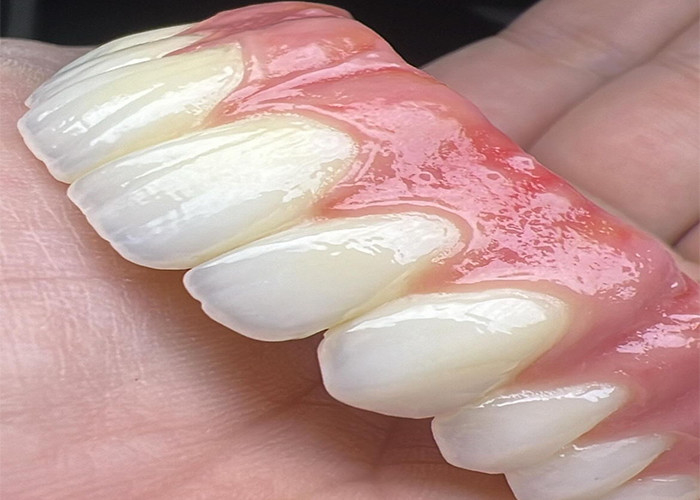 Oral Health Dental Implant Supported dentures Bridge Polished Surface Supporting Full Dentures
