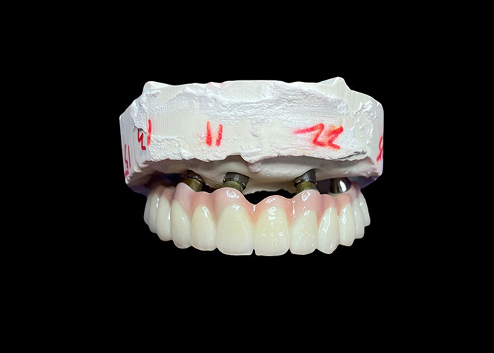Dental Implant Supported Fixed Full Arch Dentures for a Permanent, Stable, and Natural-Looking Solution to Missing Teeth