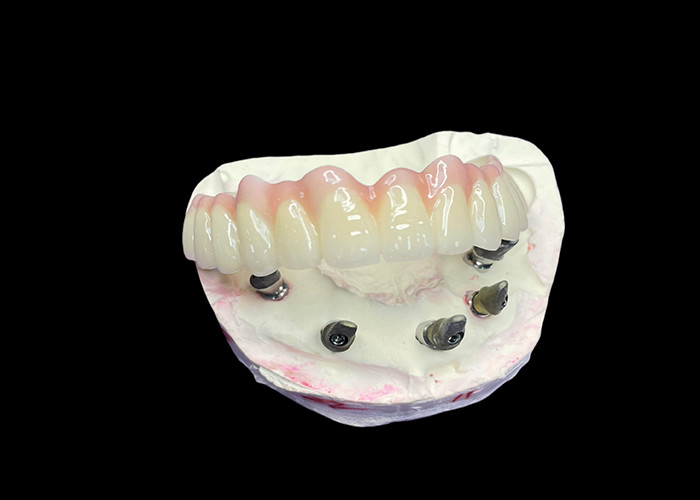Dental Implant Supported Fixed Full Arch Dentures for a Permanent, Stable, and Natural-Looking Solution to Missing Teeth