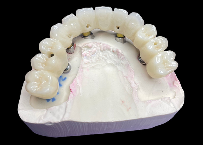 Full Arch Dental Implant Crowns and Bridges Restoring Function and Aesthetics with Advanced Solutions