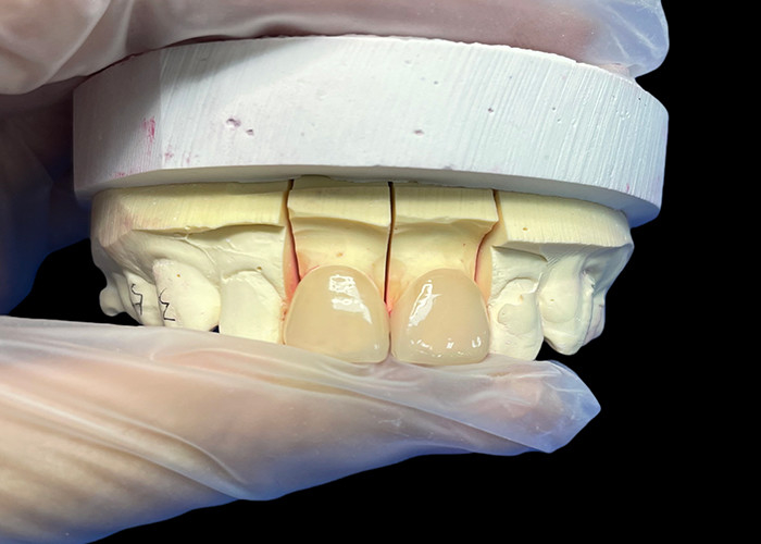 Precision Strength EMAX Porcelain Veneer incisor for Natural looking Aesthetic Restorations