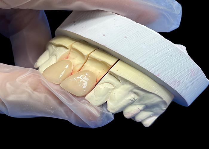 Precision Strength EMAX Porcelain Veneer incisor for Natural looking Aesthetic Restorations