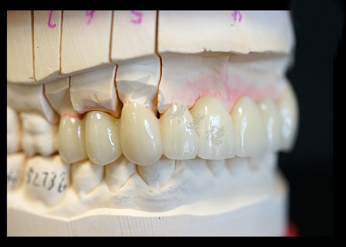 Strength Natural Esthetics Solid Zirconia Crown Perfect Fit for Single or Multiple Teeth